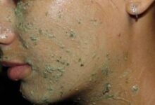 تفتيح البشرة بماسك الشاي , تفتيح البشرة الوجة 2016 طرق تفتيح الوجة بالماسك