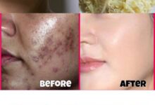 تخلص من الكلف بشكل طبيعي وسريع 2025 طرق التخلص من النمش